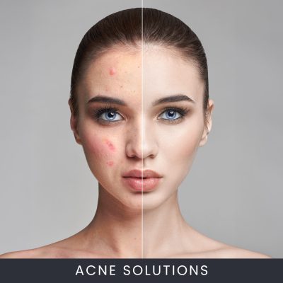 Acne Solutions