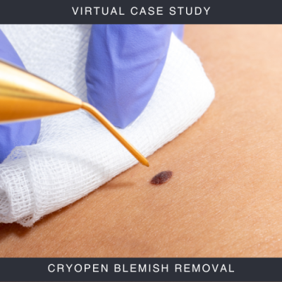 Cryo Therapy Blemish Removal Case Study